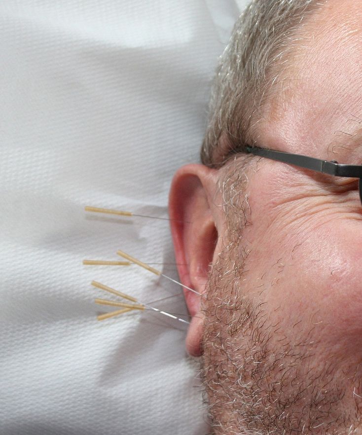 Akupunktur i ørerne